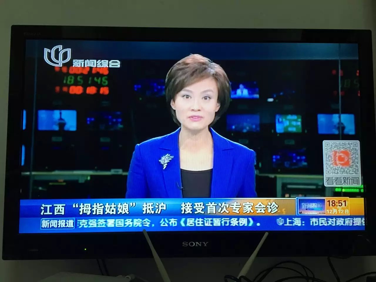 <b>上海电视台报道我院救助拇指姑娘接受多学科专家会诊</b>